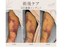 ルルアス(LuLuAS)の雰囲気（ダウンタイムケアも人気！内出血の引き・硬さ・浮腫も楽に！）