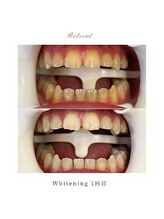 リトリート(Retreat)/ホワイトニング【1回ご来店】