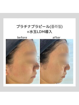 ポムハヌル 大阪梅田中崎町(pom.haneul)/韓国肌管理室