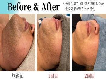 ラクツル(楽ツル24)/LED脱毛