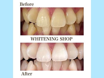 ホワイトニングショップ 守口店/before／After　10トーンUP