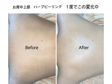 リミュール(Ri.miyuru)/背中幹細胞ハーブピーリング