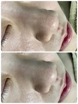 ニナル(ninal)/毛穴洗浄１回目