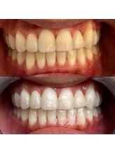 コナホワイトニング 神保町/ホワイトニング