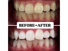 ホワイトニングサロン 豊中/Before&After美白ホワイトニング