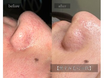 ル シーニュ/黒ずみ・詰まり毛穴30代