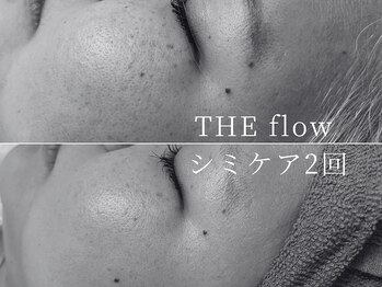 ザ フロウ(THE flow)/シミケア2回｜before/after