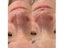 ラボーテ 岐阜店(La voute)の雰囲気（ハイドロスキンで毛穴撲滅！Before After 3回施術でこの変化♪）