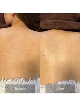 天使の艶肌/お背中のピーリング人気です☆