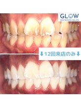 グロウ 銀座店(GLOW)/before & after