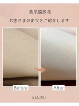 セリーニ(Selini)/全身から部分まで色々選べる脱毛