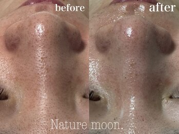 ナチュールムーン(Nature moon.)/毛穴洗浄
