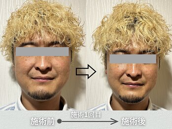 実野莉/小顔整体のブフォーアフター