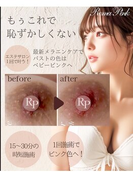 ヘアメイク エステサロン クラシカ(hairmake esthe salon clasika)の写真/憧れの明るい印象へ
黒ずみ※が気になる方へ
※古い角質や乾燥によるくすみ