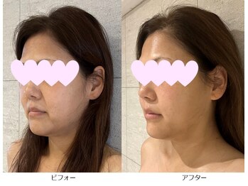 ベルメイク(BELLE MAKE)/美整コルギ☆ビフォーアフター横