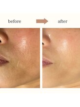 レイール(Reir)/乳酸ピーリング＋