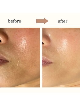 レイール(Reir)/乳酸ピーリング+