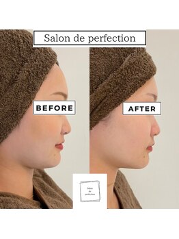 サロン ド パーフェクション(Salon de Perfection)/小顔リフト