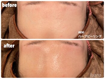 ルアナ(Luana)/【陶肌トリートメント】肌質改善