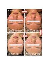 ザ モア 千葉駅前店(THE MORE)/人気NO.1ハーブピーリング！