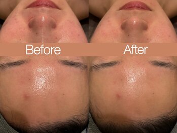 クレヴィア バイ サイバーエステ(CREBIA)/CHRISTINA【ハーブピーリング】