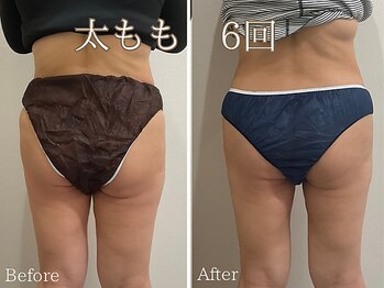 シエナ(ciena)/マグフォース(痩身)症例写真♪