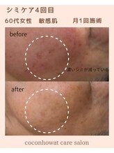 ココンフワット (Coconhouwat)/シミケア