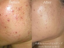 肌質別に選べるハーブピーリング♪