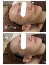 肌質改善 Laviere Flora【ラヴィエール フローラ】/フェイシャル＋ヘッドマッサージ