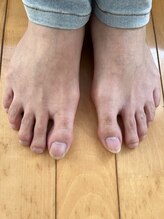ハロ(Halo)/足指脱毛