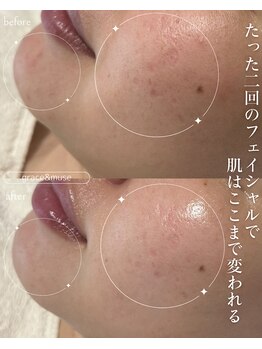 グレイス アンド ミューズ(grace&muse)/最短でお肌が変化する実感を