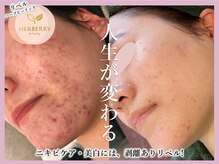 ハーバリー ハーブピーリング 大阪梅田店(HERBERRYハーブピーリング)/ハーブピーリング専門店HERBERRY