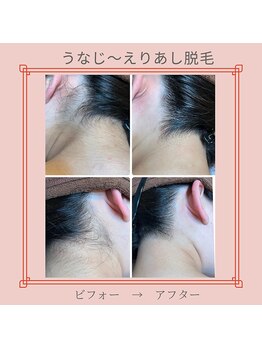 ノノ(nono)/うなじ～えりあし脱毛