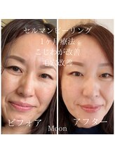 ムーン(MOON)/セルマンピーリング効果