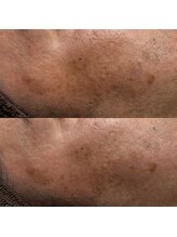 ユウユウ(YUYU)/純粋レチノールピール