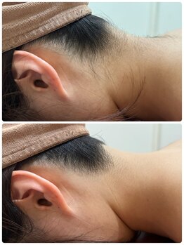 エステティック レイビス 銀座店(RAYVIS)/IPL脱毛