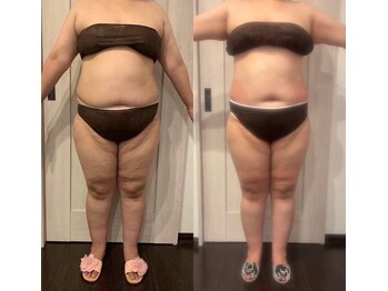 エステサロン ロティオン/TVでも話題急上昇脂肪冷却