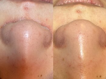 ヴィーヴ 京橋(vive)/【韓国式3D毛穴洗浄】