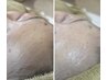 韓国女優のような水光肌に♪シミ美白コース/ヒト幹細胞×ピーリング8000円