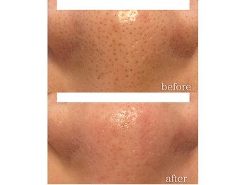 モニ 福岡(Moni)/ハーブピーリング で毛穴ケア