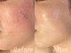 バース(Birth...)の写真/1ヶ月集中【ハーブピーリング(全顔)3回27000円】ダウンタイムの無い毛穴レス美肌施術が1回9000円で☆