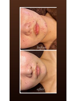 雅菜(miyabina)/長年のお悩みニキビケア肌質改善