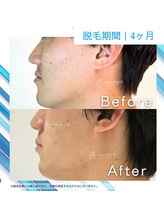 メンズクリア 鳥取駅前店/【メンズクリア】お客様の施術例