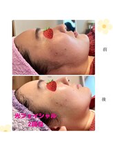 ローズ 下松(ROSE)/スッキリシャープな肌へ