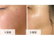 ラビエス(LAVIES)/【30代】長年の悩みから解放