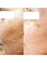 アーネスト 大阪心斎橋店(EARNEST)/PHA＋水光【 エイジングケア 】