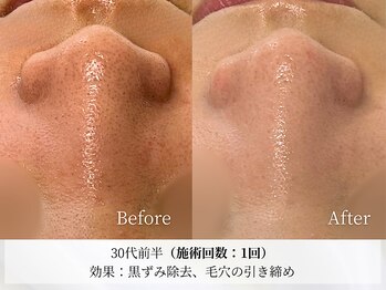 アストリエ グレース 相模大野(Astorie Grace)/毛穴洗浄&吸引 1回でも効果◎