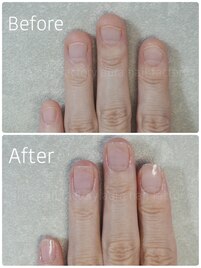 最強のネイルケア3ヶ月コース