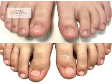 深爪矯正 爪悩み専門店 cocomo/(深爪/長さだし/フィルイン)