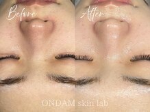 オンダム 南青山 表参道(ONDAM)/【毛穴の詰まり・開き】